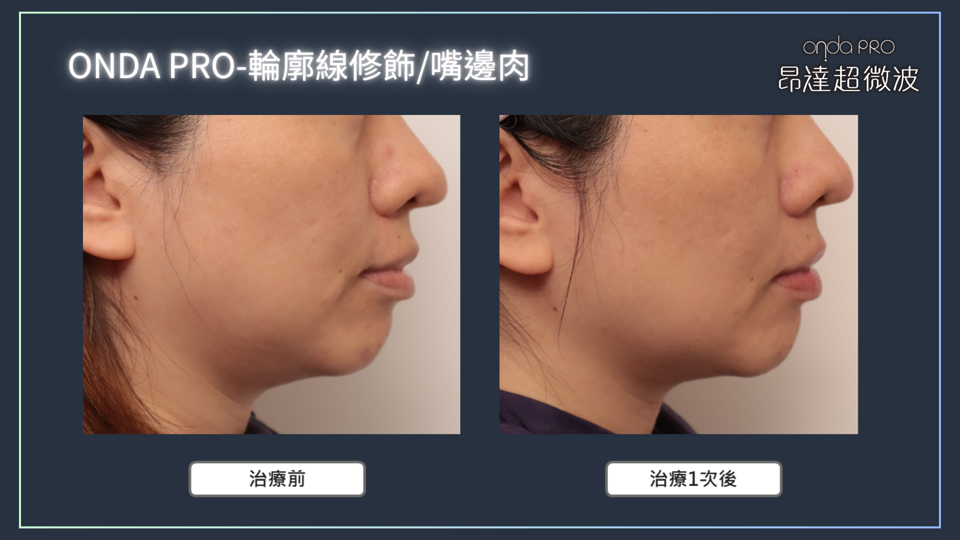 ONDA PRO-輪廓線修飾:嘴邊肉