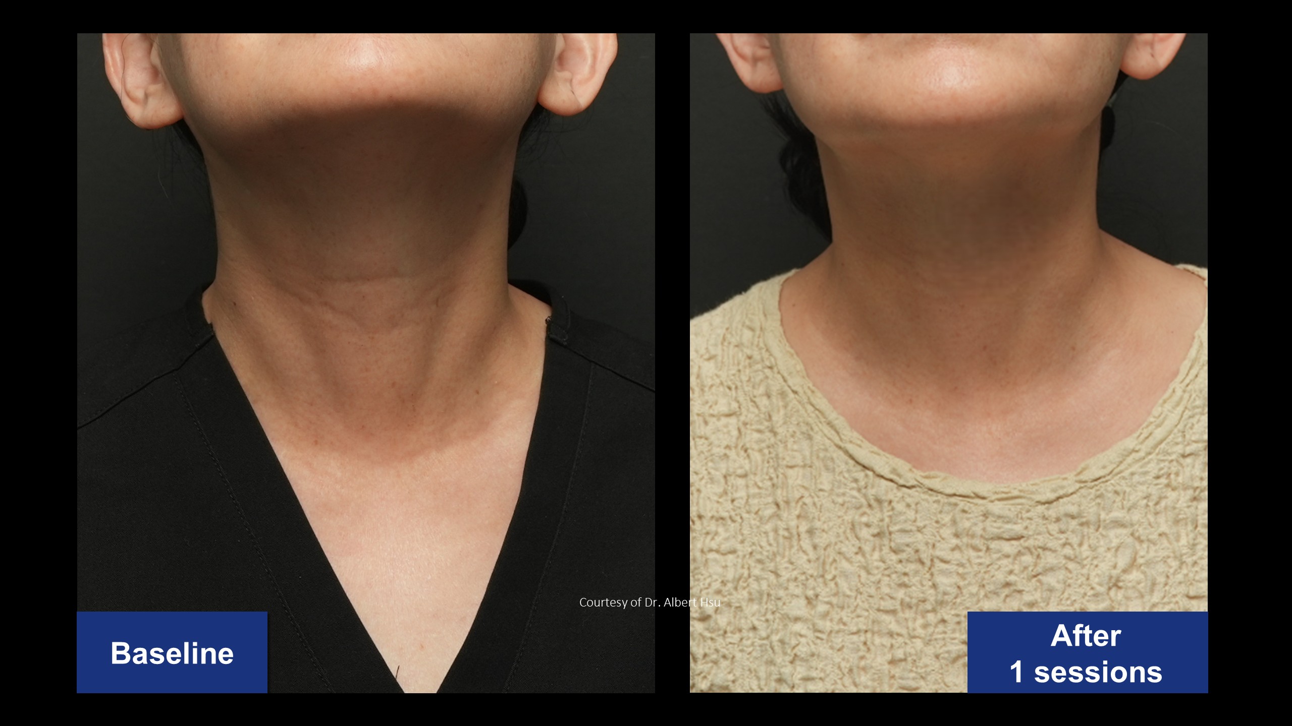 Neck Model2-1